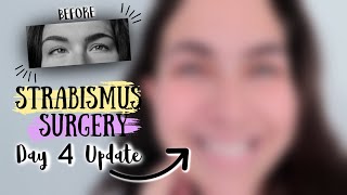 FOUR DAYS postop STRABISMUS EYE SURGERY UPDATE QampA 2019 [upl. by Einnep895]