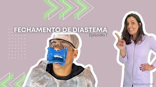 Fechamento de Diastema [upl. by Arratal]