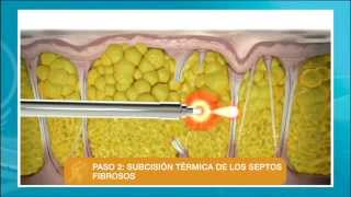 Eliminar la celulitis con el láser Cellulaze [upl. by Korie]