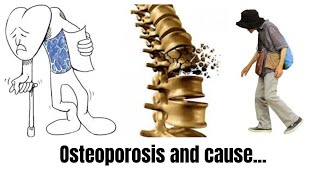 quotUnderstanding Osteoporosis Causes and Risk Factors Explainedquot [upl. by Bergeron]