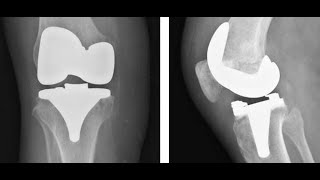 Artroplastia do Joelho EVOLUÇÃO TRATAMENTO PÓS OPERATÓRIO  Clínica de Fisioterapia Dr Robson Sitta [upl. by Ynar767]