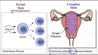 Video 254 Hydatidiform Mole Molar Pregnancy Partial vs Complete Mole amp Associated Risk Factors [upl. by Ahsennek918]