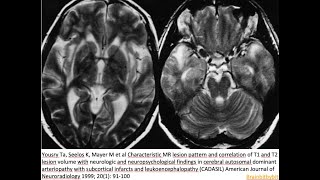 70 CADASIL Notch3 arteriopathy pericyt blood brain barrier anterior temporal pole stroke [upl. by Eneja]