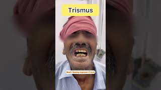 Trismus Treatment shorts trismus mouthcancer [upl. by Llerruj]