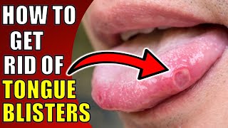 How to Get Rid of Tongue BlistersCanker Sores TOP TEN REMEDIES FOR TONGUE ULCERS [upl. by Chuah757]