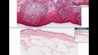 Histopathology Skin Furuncle abscess [upl. by Ojyllek]