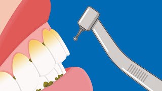 how much do you know about dental scaling [upl. by Elaina]