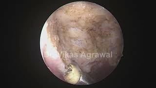 coblation adenoids boundaries defined [upl. by Arreis]