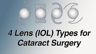 4 Main Lens IOL Types for Cataract Surgery Pros and Cons Basic Version [upl. by Ishmael]