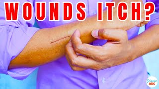 Why Do Healing Wounds Itch [upl. by Adgam]