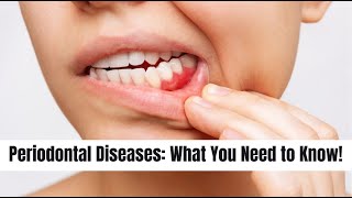 Periodontal Diseases What You Need to Know  Mind Musings dentistry dentaldisease oralhealth [upl. by Snoddy251]