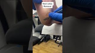 Witness the expert skills of an Aussie podiatrist in action Say goodbye to heel callus [upl. by Graniah]