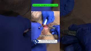 Removal  surgery of Giant wart  keratoacanthoma  wart का इलाज  Achil treatment Dr Uttam Lenka [upl. by Ange]