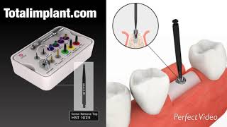 DENTAL IMPLANT removal kit aftercare complications pain code tool replacement dentistry oral surgery [upl. by So214]