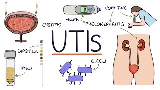 Understanding Urinary Tract Infections [upl. by Leafar584]