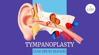 Eardrum Hole Repair Tympanoplasty  How it is done  After Tympanoplasty Care  CARE Hospitals [upl. by Eceinej411]