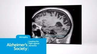 What is posterior cortical atrophy [upl. by Tdnerb210]