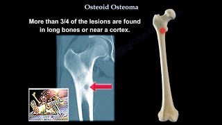 Osteoid Osteoma  Everything You Need To Know  Dr Nabil Ebraheim [upl. by Tteragram]