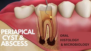 Periapical Cyst amp Abscess [upl. by Terraj]