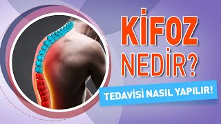 Kifoz Nedir Kifoz Belirtileri Nelerdir Kifoz Tedavisi Nasıl Yapılır [upl. by Annahsohs]