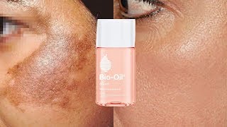 Remove Pigmentation Dark Spots amp Acne Scars Easily at Home  Bio Oil for Skin Pigmentation [upl. by Goldi]