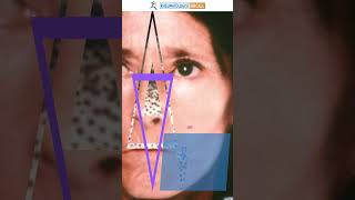 AntiSCL 70 Antibodies Their Role in Diagnosing Scleroderma [upl. by Nerhe]