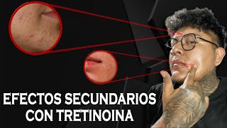 Efectos secundarios de la Tretinoina  Mi experiencia 👨🏻‍🔬 [upl. by Neih]