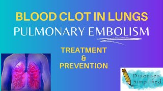 Blood Clot in Lung Treatment amp Prevention [upl. by Menides]