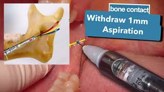 INFERIOR ALVEOLAR NERVE BLOCK أفضل شرح مبسط لطبيب الأسنان [upl. by Corvese]