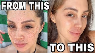 MY SKINCARE SECRETS  HOW I GOT RID OF MY FRECKLES [upl. by Alena944]