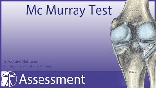 McMurray Test  Meniscus Damage update in description [upl. by Weatherby809]