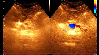 Ultrasonogram of Chronic Pancreatitis Key Findings and Diagnosis  Chronic Pancreatitis [upl. by Beulah]