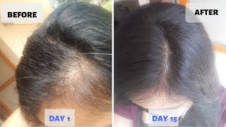 OMG  15 Days Hair Growth Miracle Treatment  Grow Long Thicken Hair  100 works [upl. by Filler]