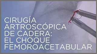 Cirugía artroscópica de cadera el choque femoroacetabular por el Dr Ángel Villamor [upl. by Revert]