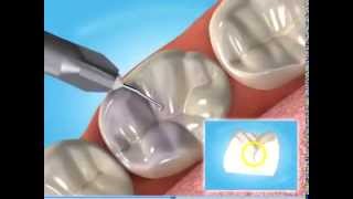 Molar Fissure  sealants [upl. by Asilehc]