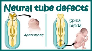 Neural Tube Defect  Overview  signs and symptoms of neural tube defect pathophysiology amp treatment [upl. by Eniliuqcaj162]