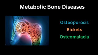 Metabolic bone disease Osteoporosis Rickets amp Osteomalacia A complete guide [upl. by Jurgen]