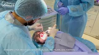 Autotransplantation of mature 3rd Molar [upl. by Eednam]