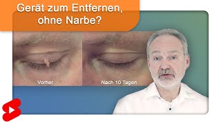 Fibrome ohne Narbe und Betäubung entfernen Shorts [upl. by Aicyle683]