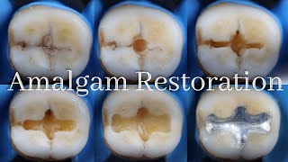 Amalgam Restoration ⚪️ Class I Amalgam Cavity Preparation amp Restoration [upl. by Ydnil]