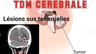 SCANNER CEREBRAL  Lésions sus tentorielles droites séquellaires [upl. by Aniri]