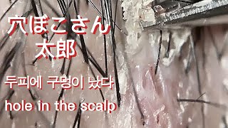 No167 頭皮引き剥がす感  peel off scalp scabs  costras del cuero cabelludo keratin plug peeling off [upl. by Limak]