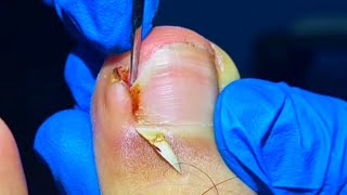 THE FASTEST Way to Get Instant Relief from Infected Ingrown Toenails [upl. by Eseenaj203]