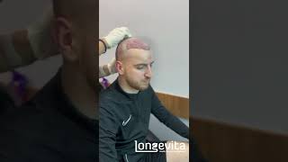 How Easy Can A Hair Transplant Be Very Much  Longevita [upl. by Ahsats]