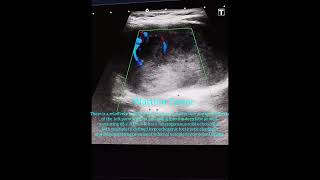 Warthin Tumor Parotid Gland Ultrasound [upl. by Isnyl]