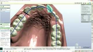 3Shape Orthodontics 2010 Video  تقويم الأسنان Ortho [upl. by Higbee]