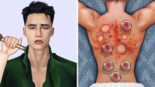 ASMR Cupping Therapy amp Back Acne Removal [upl. by Attinahs192]