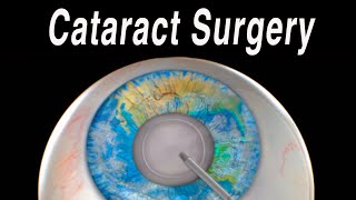 Cataract Eye Surgery Animation [upl. by Anairuy419]