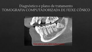 DIAGNÃ“STICO E PLANO DE TRATAMENTO  TOMOGRAFIA COMPUTADORIZADA DE FEIXE CÃ”NICO [upl. by Gigi]