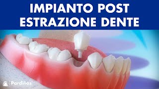 Impianto dentale immediato postestrazione dente © [upl. by Ayahc]